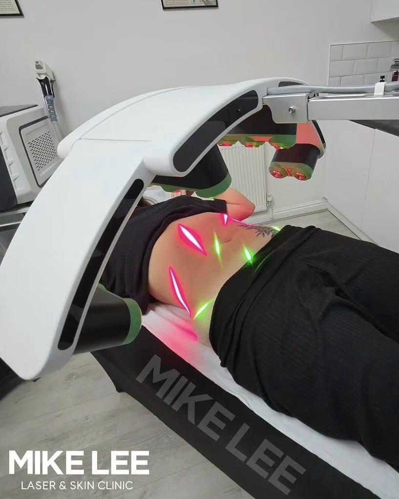 10D laser lipolysis treatment on the abdomen at Mike Lee Laser & Skin Clinic