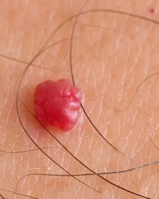 A close-up of a cherry angioma on the skin at Mike Lee Laser & Skin Clinic