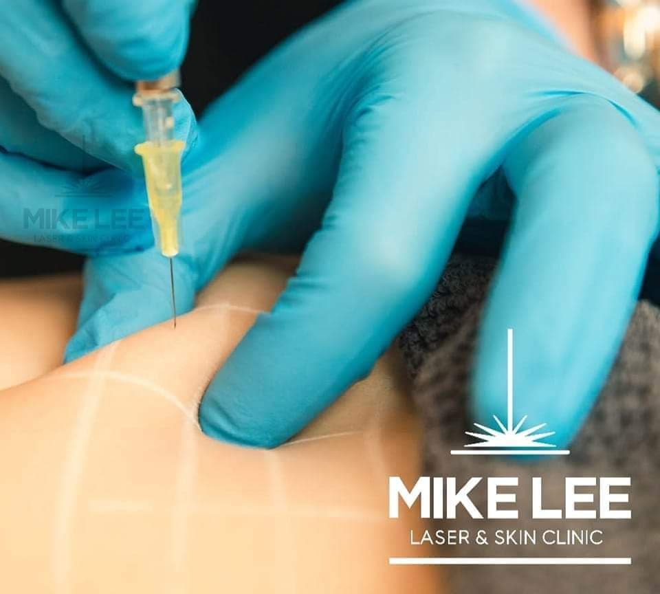 Fat Dissolving Injections at Mike Lee Laser & Skin Clinic