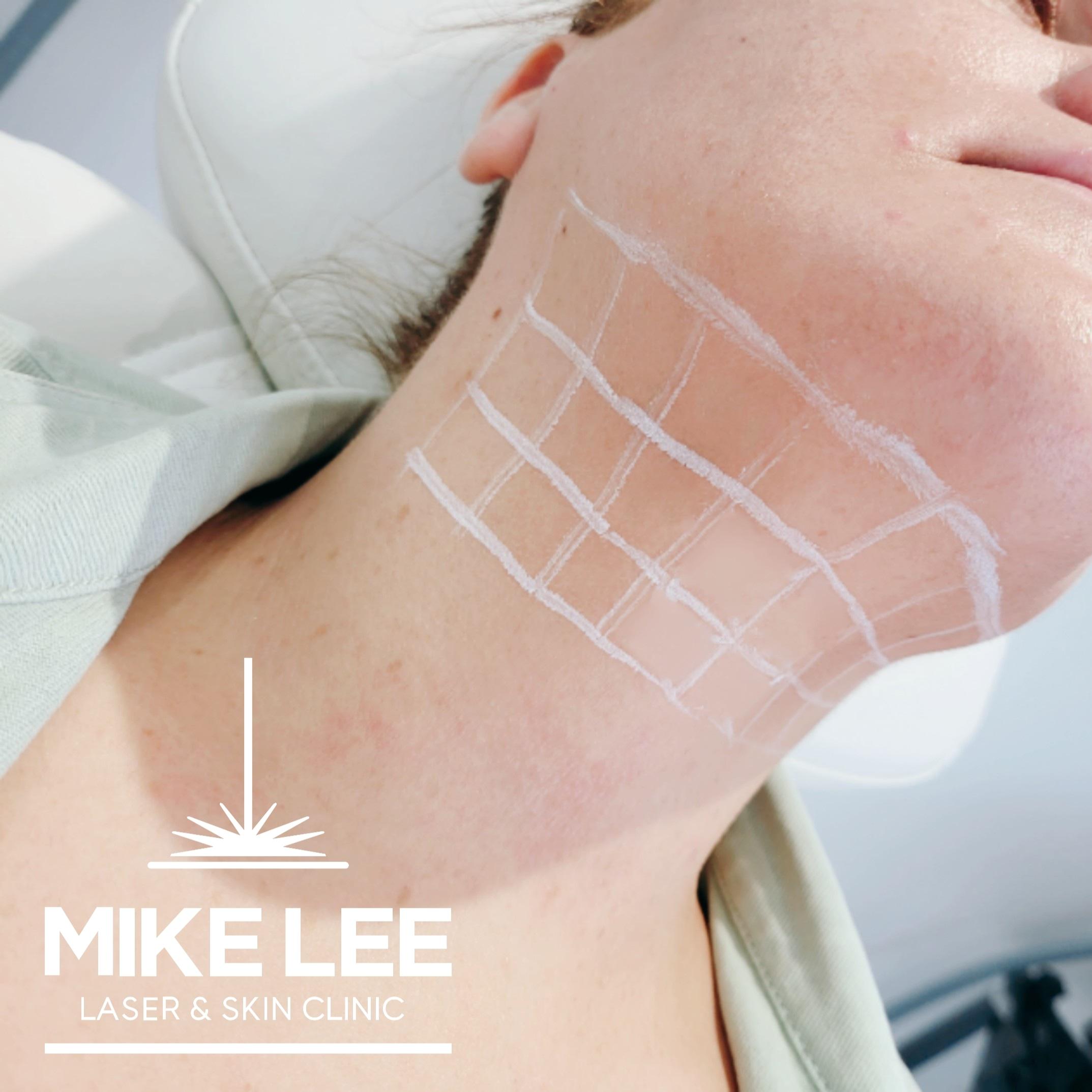 Fat Dissolving Injections at Mike Lee Laser & Skin Clinic