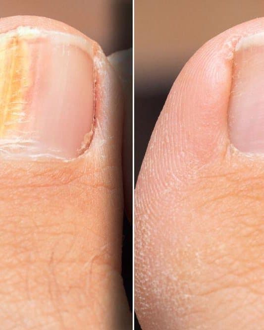 A toenail before and after fungal nail treatment at Mike Lee Laser & Skin Clinic