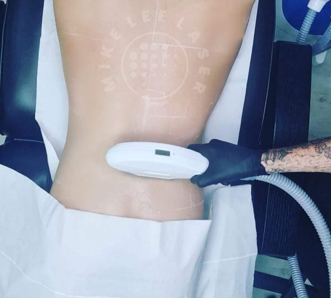 Hair removal at Mike Lee Laser & Skin Clinic