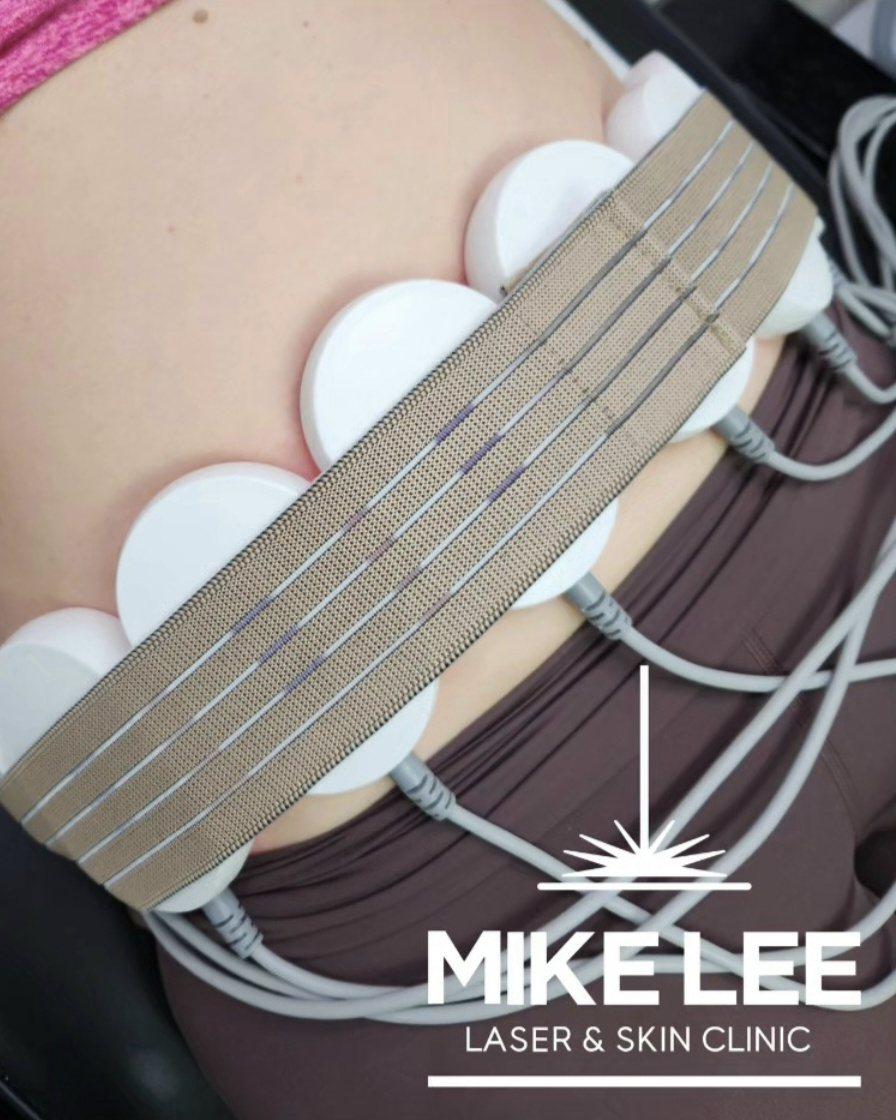 Laser lipolysis pads and strap on a client's waist at Mike Lee Laser & Skin Clinic