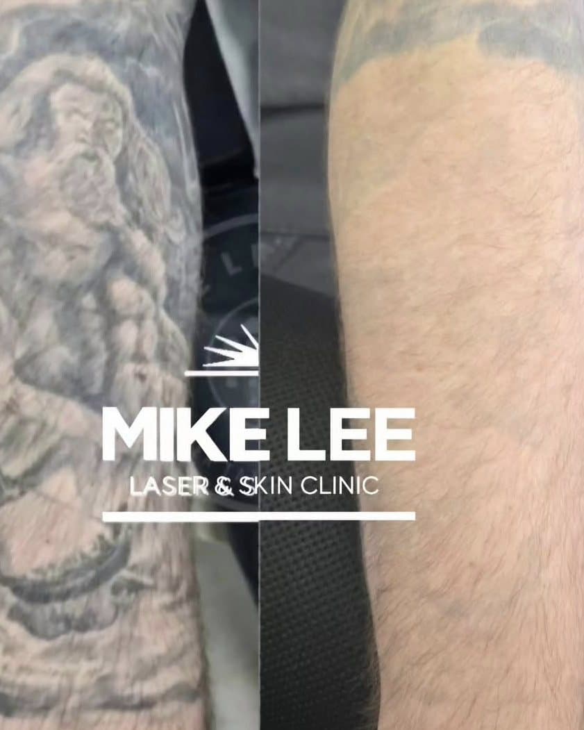 Laser tattoo removal at Mike Lee Laser & Skin Clinic