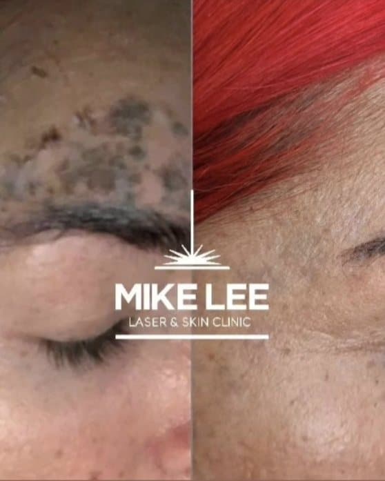 Tattoo pigment above an eyebrow before and after laser removal at Mike Lee Laser & Skin Clinic