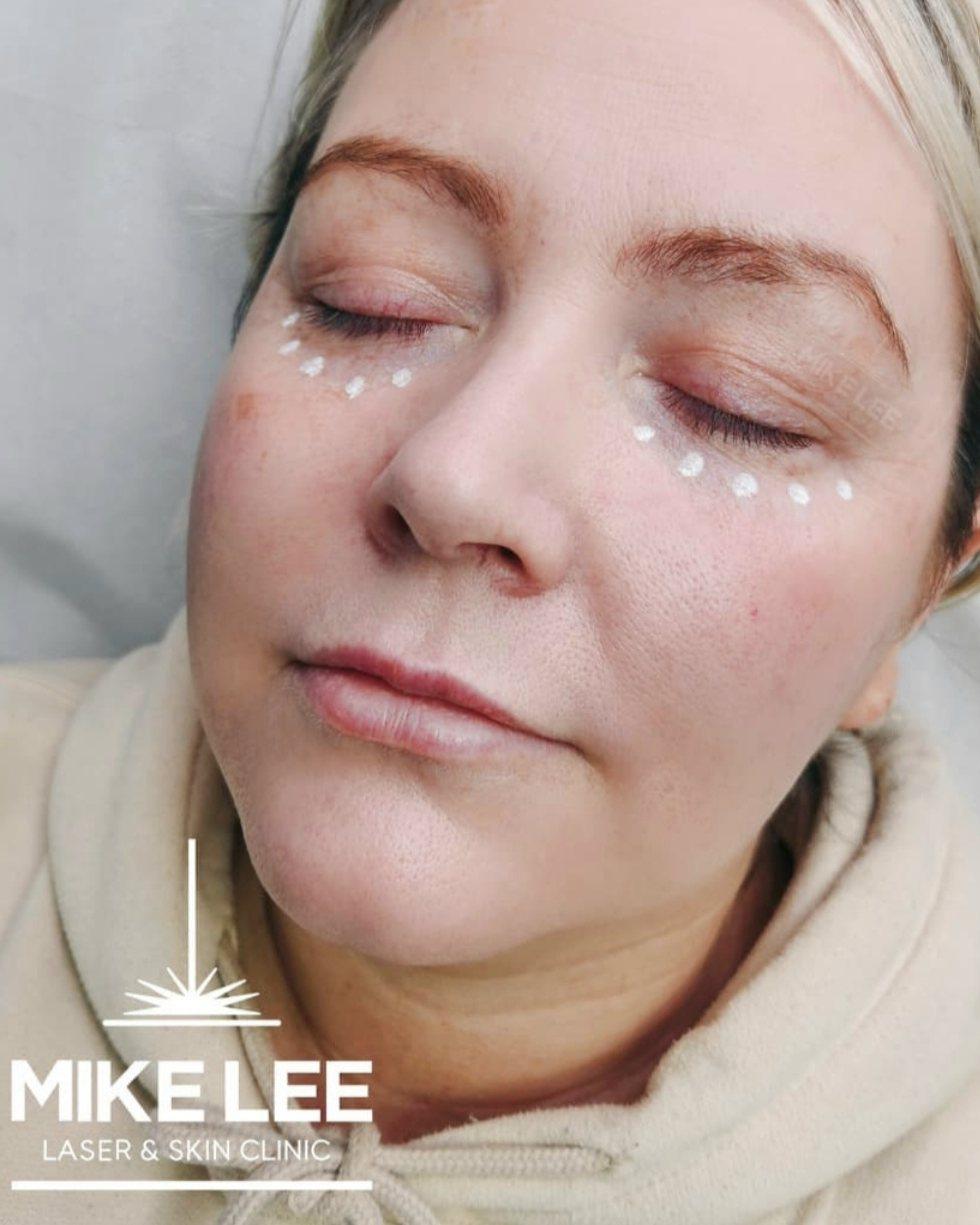 A client after Lumi Eyes treatment, with marks under the eyes at Mike Lee Laser & Skin Clinic
