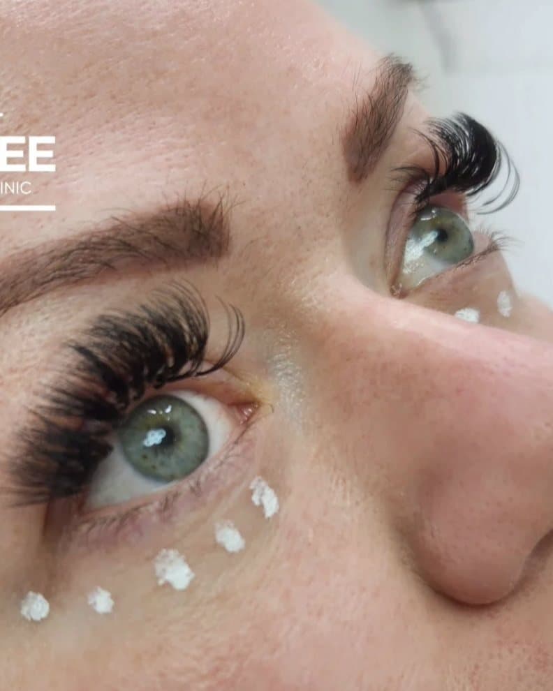 Close-up of the eye area during Lumi Eyes treatment at Mike Lee Laser & Skin Clinic