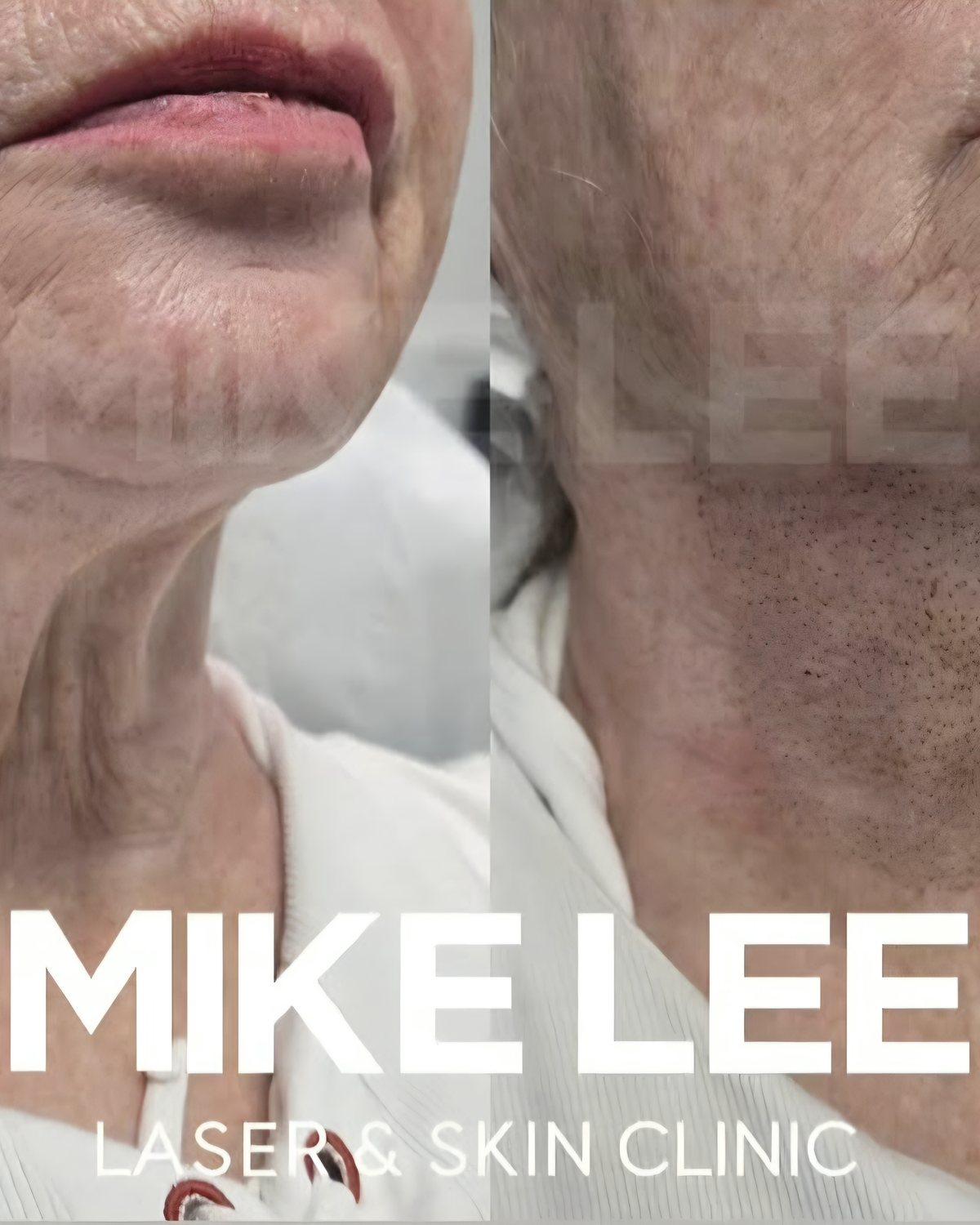 Skin tightening and rejuvenation at Mike Lee Laser & Skin Clinic
