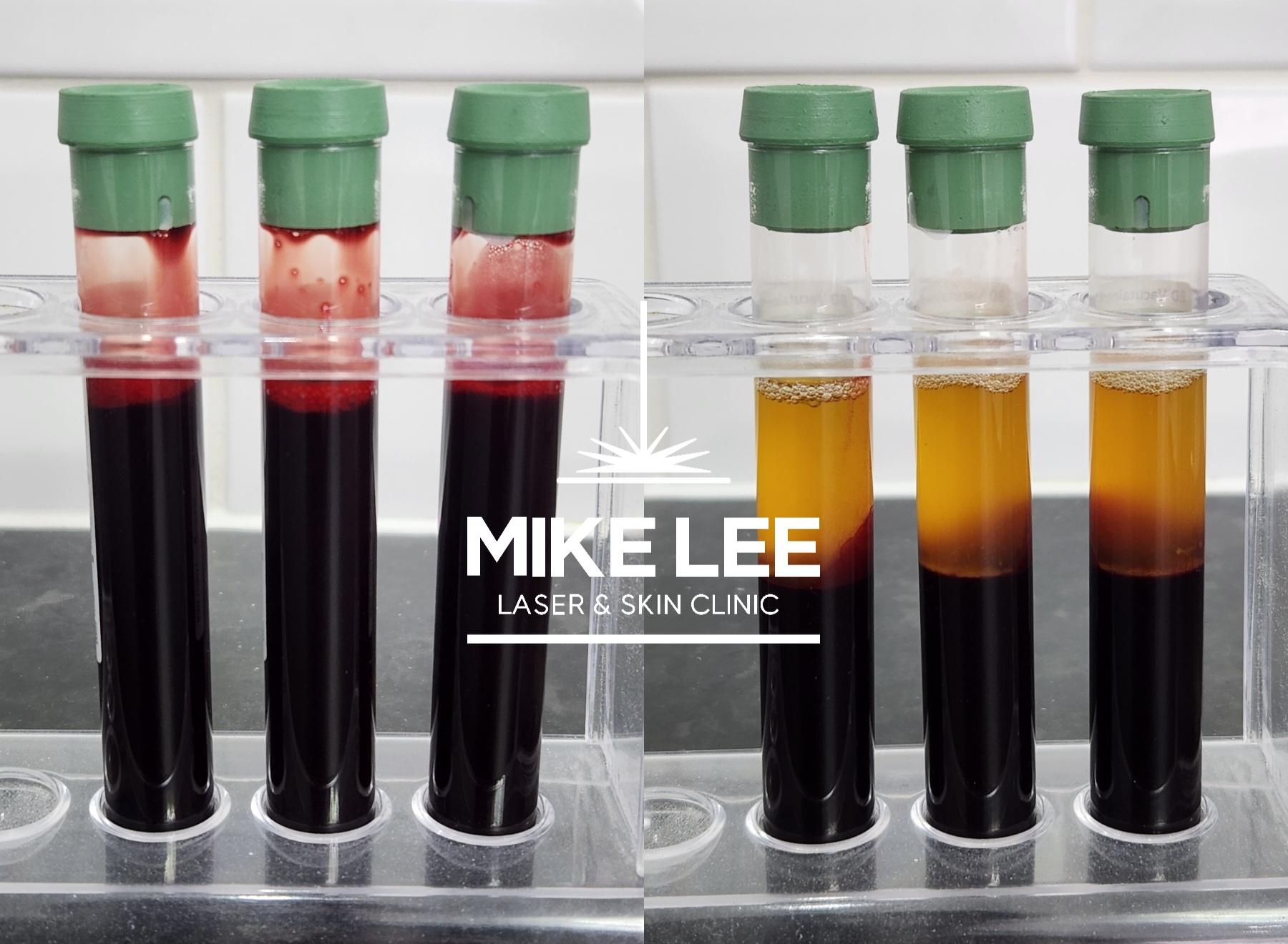 PRP Injections at Mike Lee Laser & Skin Clinic