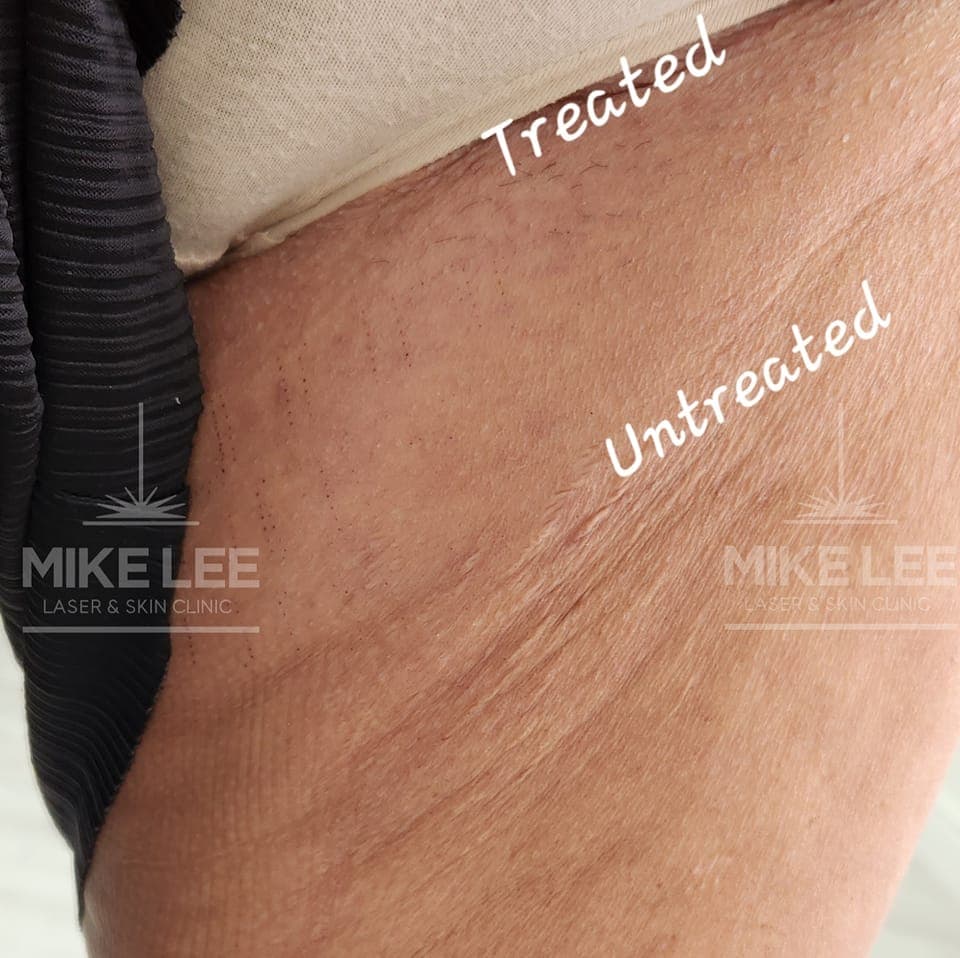 Radio Frequency Microneedling at Mike Lee Laser & Skin Clinic