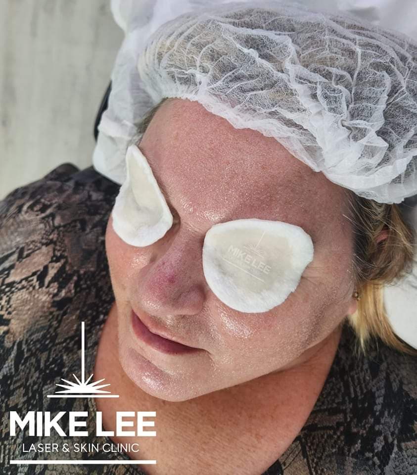 Skin Peels at Mike Lee Laser & Skin Clinic