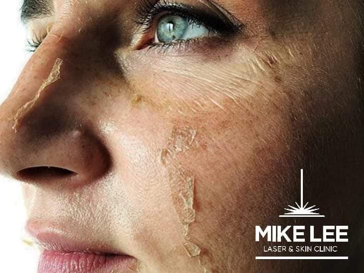 Skin Peels at Mike Lee Laser & Skin Clinic