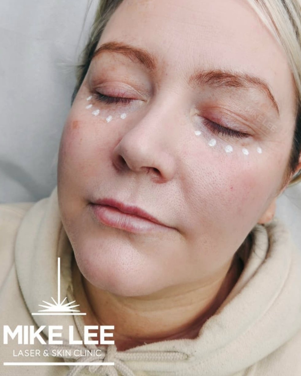 A client after Lumi Eyes treatment, with marks under the eyes at Mike Lee Laser & Skin Clinic