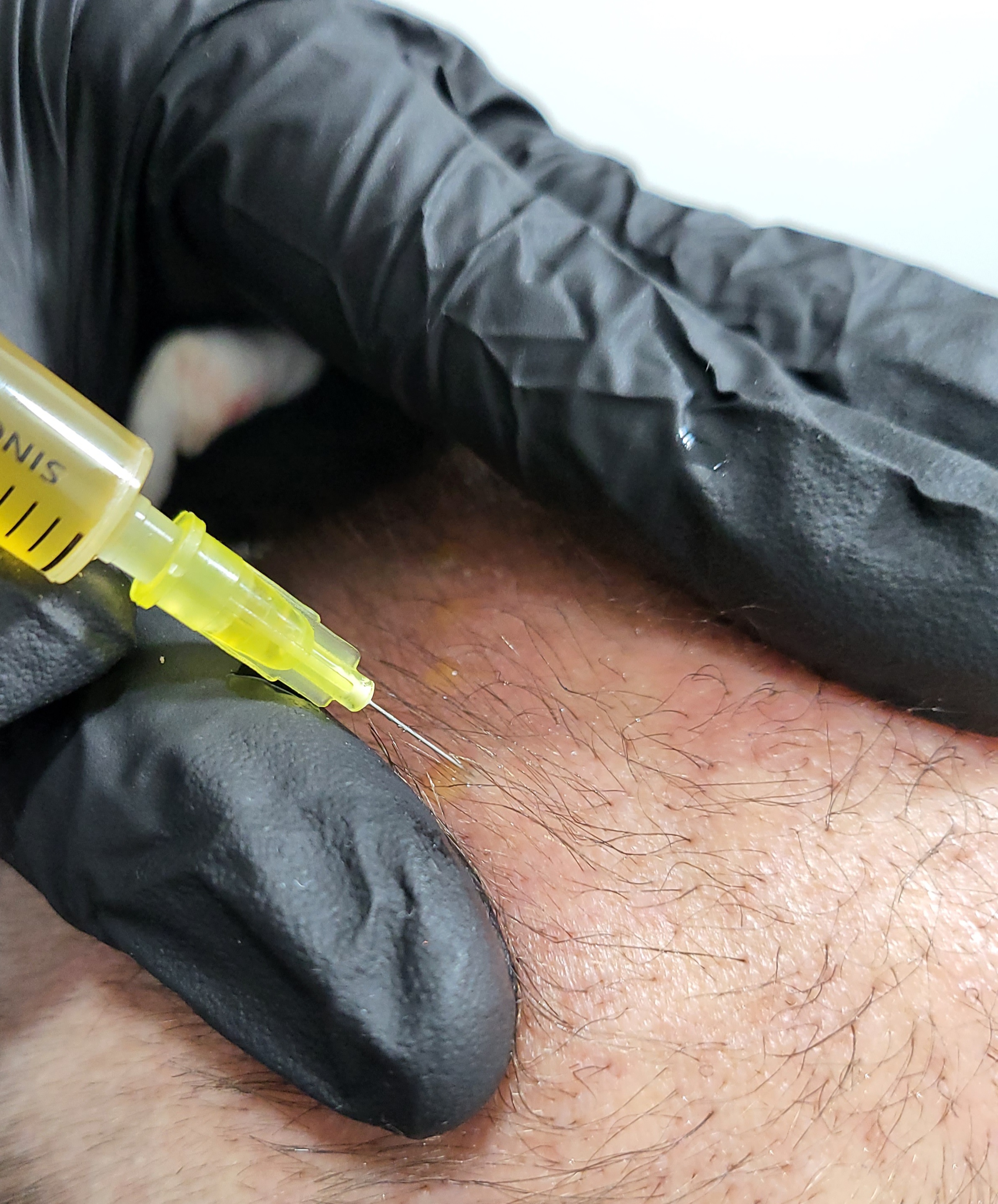 PRP Injections at Mike Lee Laser & Skin Clinic