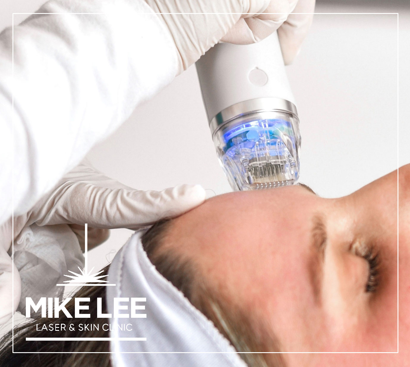Radio Frequency Microneedling at Mike Lee Laser & Skin Clinic