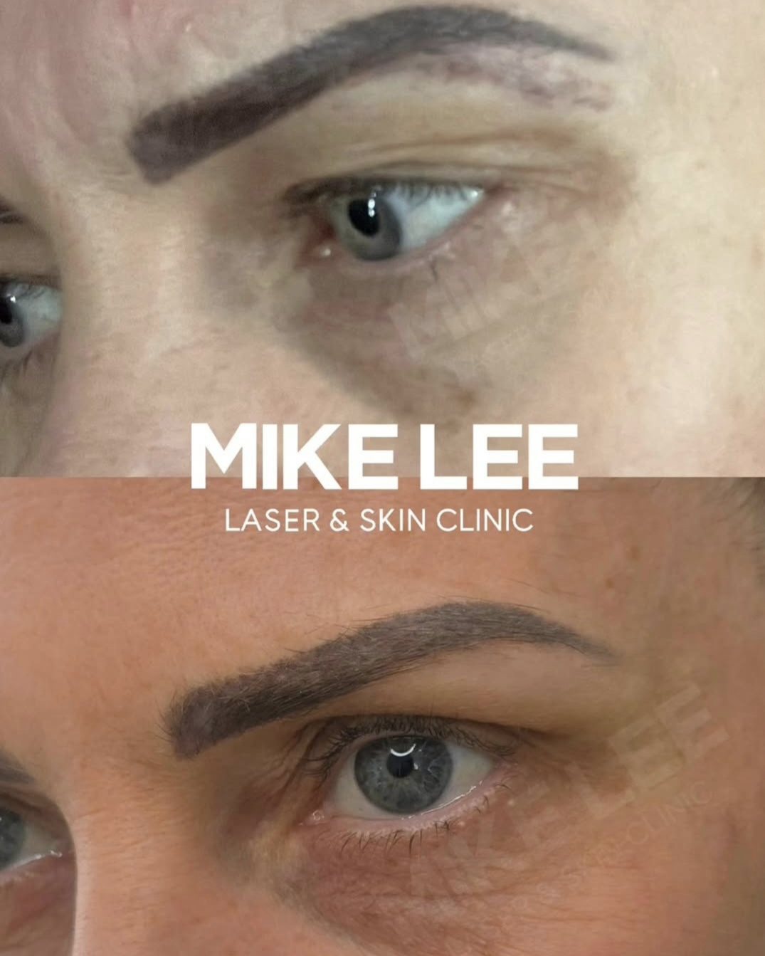 Eyebrows before and after tattoo brow removal at Mike Lee Laser & Skin Clinic