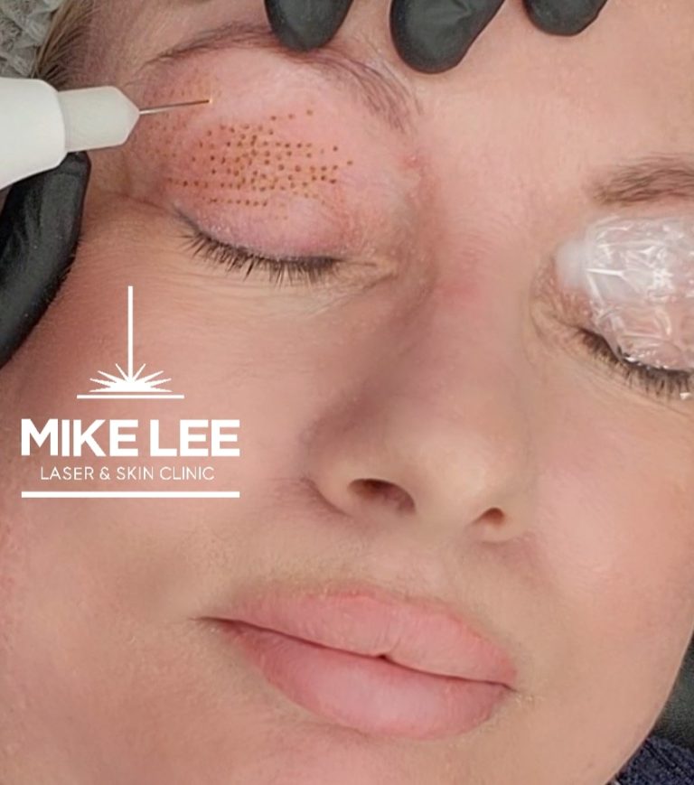 Plasma Skin Tightening Mike Lee Laser And Skin Clinic